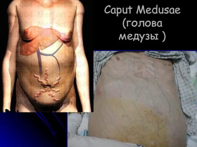 Caput Medusae (голова медузы )