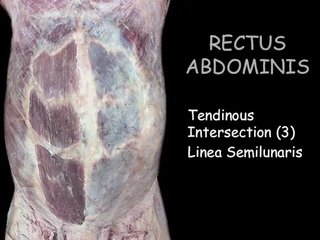 RECTUS ABDOMINIS Tendinous Intersection (3) Linea Semilunaris