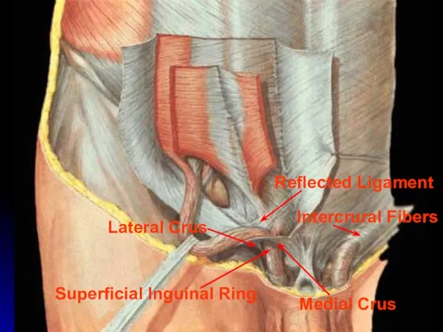 Superficial Inguinal Ring Medial Crus Lateral Crus Intercrural Fibers Reflected Ligament
