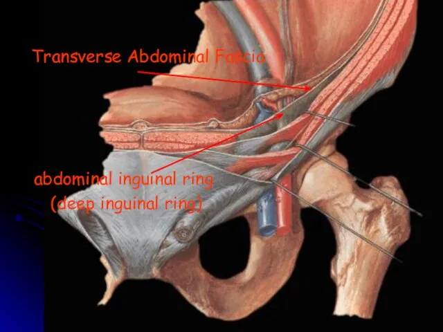 Transverse Abdominal Fascia abdominal inguinal ring (deep inguinal ring)