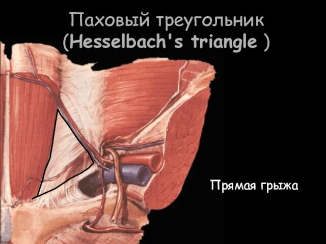 Паховый треугольник (Hesselbach's triangle ) Прямая грыжа