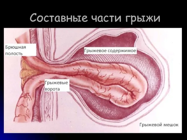 Составные части грыжи