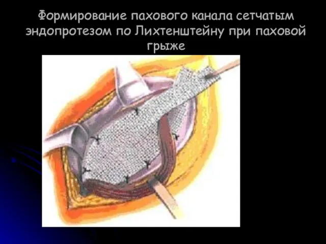 Формирование пахового канала сетчатым эндопротезом по Лихтенштейну при паховой грыже