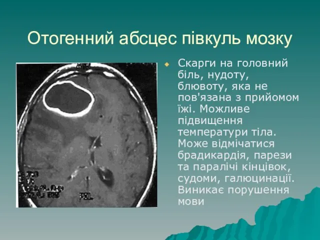 Отогенний абсцес півкуль мозку Скарги на головний біль, нудоту, блювоту, яка