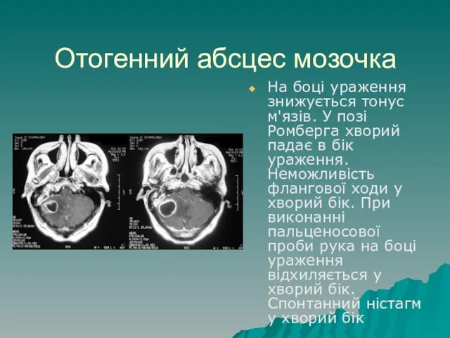 Отогенний абсцес мозочка На боці ураження знижується тонус м'язів. У позі