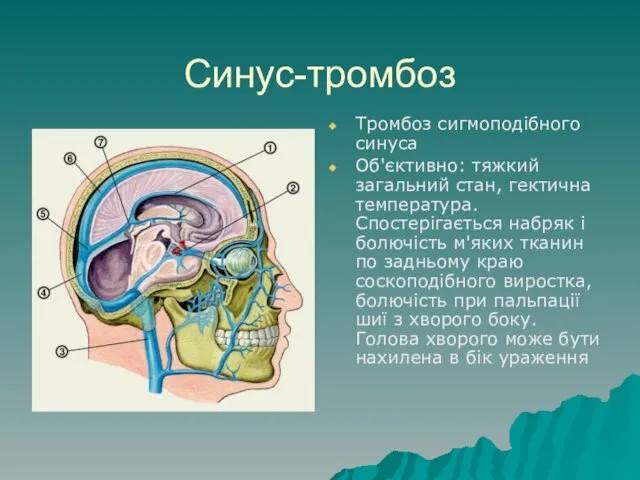 Синус-тромбоз Тромбоз сигмоподібного синуса Об'єктивно: тяжкий загальний стан, гектична температура. Спостерігається