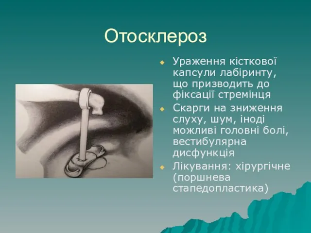 Отосклероз Ураження кісткової капсули лабіринту, що призводить до фіксації стремінця Скарги