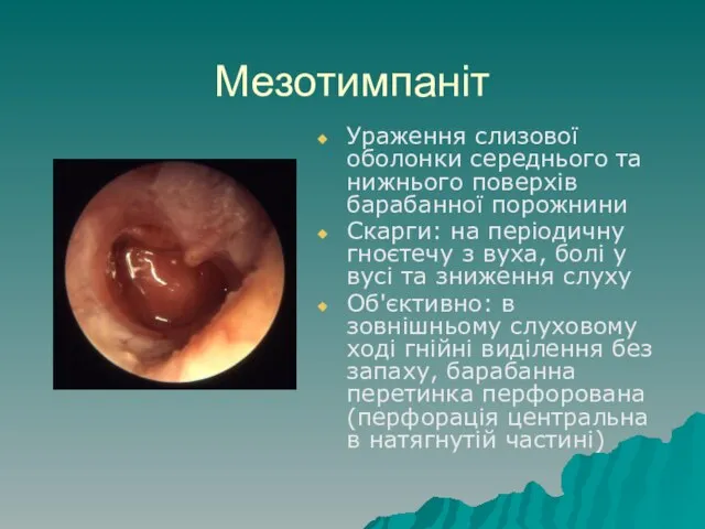 Мезотимпаніт Ураження слизової оболонки середнього та нижнього поверхів барабанної порожнини Скарги: