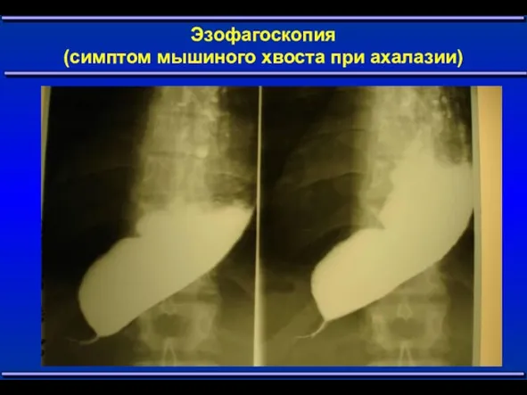 Эзофагоскопия (симптом мышиного хвоста при ахалазии)