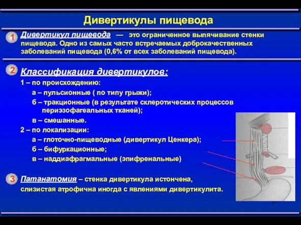 1 Дивертикулы пищевода Дивертикул пищевода — это ограниченное выпячивание стенки пищевода.