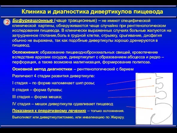 2 Клиника и диагностика дивертикулов пищевода Бифуркационные (чаще тракционные) – не