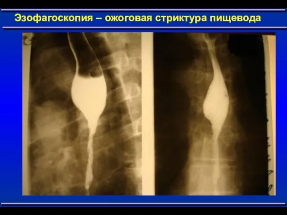 Эзофагоскопия – ожоговая стриктура пищевода