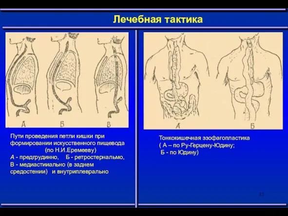 Лечебная тактика Пути проведения петли кишки при формировании искусственного пищевода (по