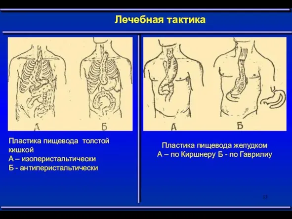 Лечебная тактика Пластика пищевода толстой кишкой А – изоперистальтически Б -