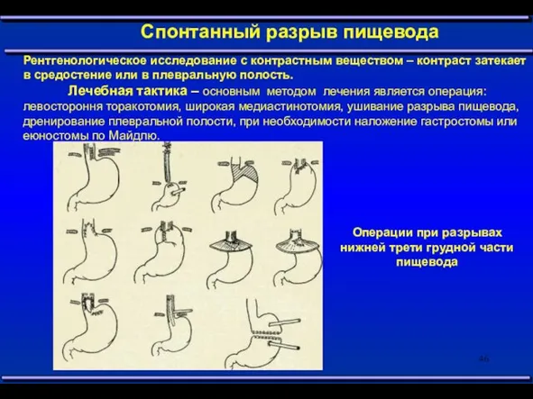 Спонтанный разрыв пищевода Рентгенологическое исследование с контрастным веществом – контраст затекает