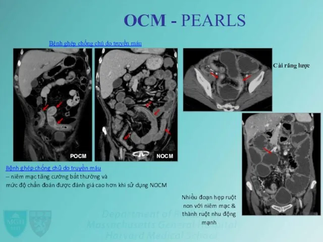 OCM - PEARLS Bệnh ghép chống chủ do truyền máu Cài