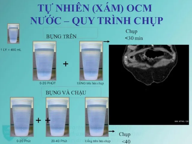 TỰ NHIÊN (XÁM) OCM NƯỚC – QUY TRÌNH CHỤP Chụp BỤNG