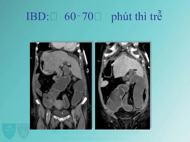 IBD:ꢀ 60‐70ꢀ phút thì trễ