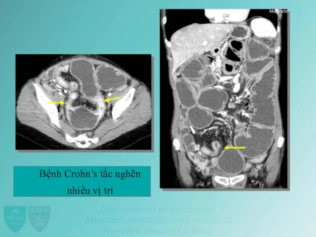 Bệnh Crohn’s tắc nghẽn nhiều vị trí