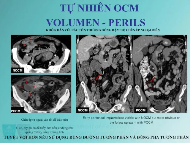 TỰ NHIÊN OCM VOLUMEN - PERILS KHÓ KHĂN VỚI CÁC TỔN