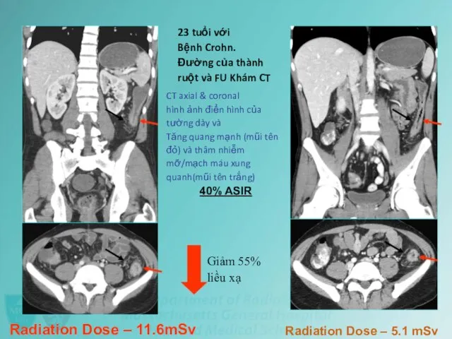 23 tuổi với Bệnh Crohn. Đường của thành ruột và FU