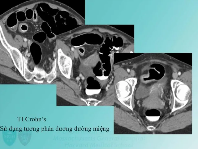 TI Crohn’s Sử dụng tương phản dương đường miệng