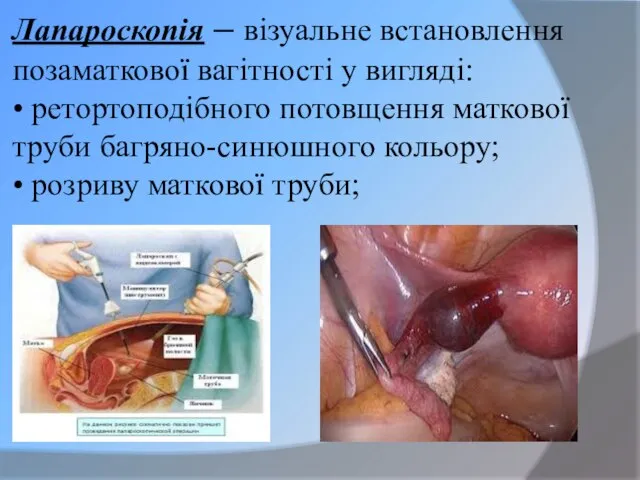 Лапароскопія – візуальне встановлення позаматкової вагітності у вигляді: • ретортоподібного потовщення