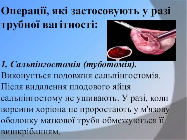 Операції, які застосовують у разі трубної вагітності: 1. Сальпінгостомія (туботомія). Виконується