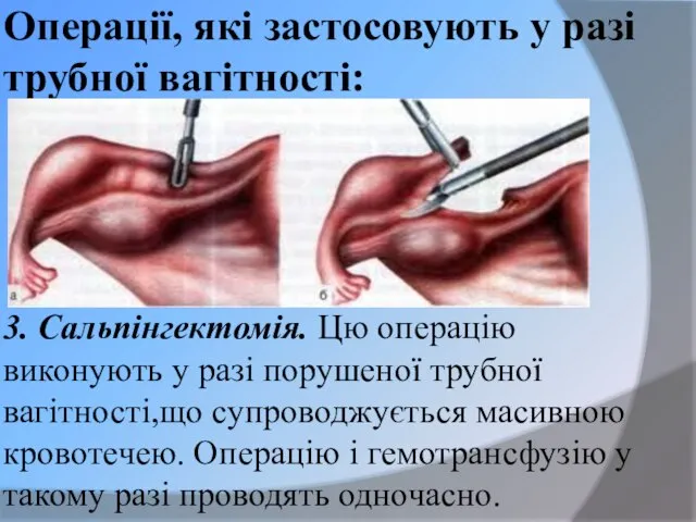 Операції, які застосовують у разі трубної вагітності: 3. Сальпінгектомія. Цю операцію