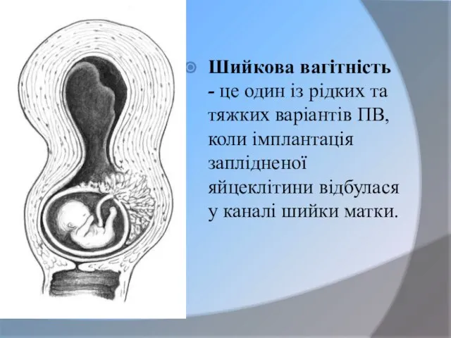 Шийкова вагітність - це один із рідких та тяжких варіантів ПВ,