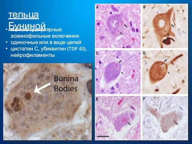 тельца Буниной мелкие гранулярные эозинофильные включения одиночные или в виде цепей