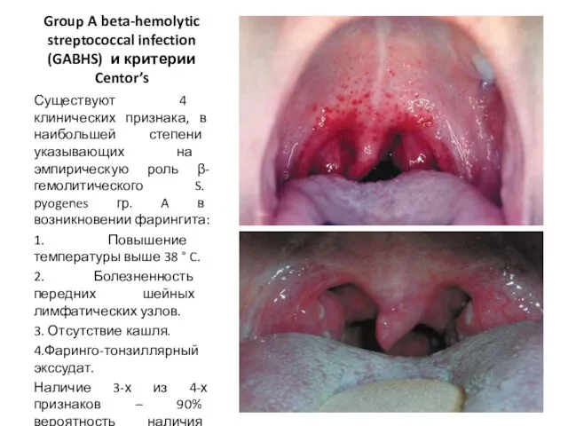 Group A beta-hemolytic streptococcal infection (GABHS) и критерии Centor’s Существуют 4