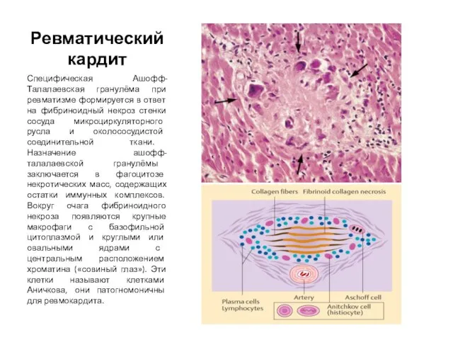 Ревматический кардит Специфическая Ашофф-Талалаевская гранулёма при ревматизме формируется в ответ на