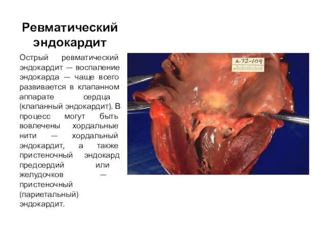 Ревматический эндокардит Острый ревматический эндокардит — воспаление эндокарда — чаще всего