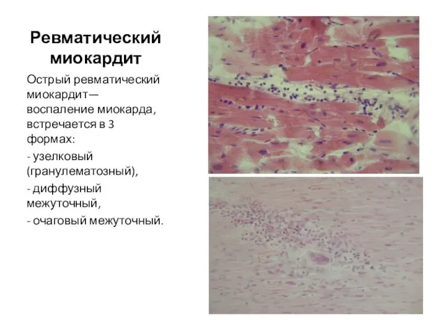 Ревматический миокардит Острый ревматический миокардит— воспаление миокарда, встречается в 3 формах: