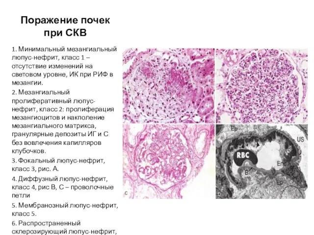 Поражение почек при СКВ 1. Минимальный мезангиальный люпус-нефрит, класс 1 –
