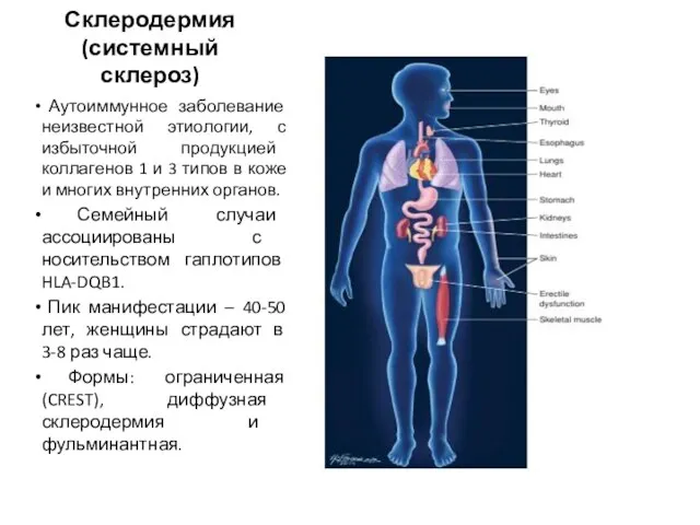 Склеродермия (системный склероз) Аутоиммунное заболевание неизвестной этиологии, с избыточной продукцией коллагенов