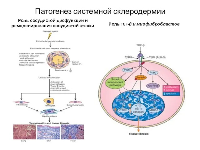 Патогенез системной склеродермии Роль сосудистой дисфункции и ремоделирования сосудистой стенки Роль TGF-β и миофибробластов