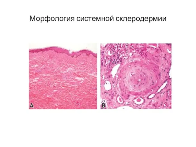 Морфология системной склеродермии