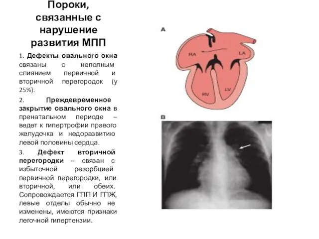 Пороки, связанные с нарушение развития МПП 1. Дефекты овального окна связаны