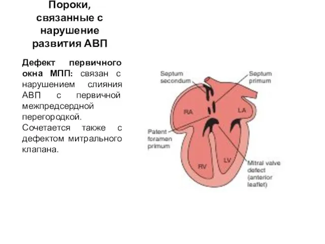 Пороки, связанные с нарушение развития АВП Дефект первичного окна МПП: связан