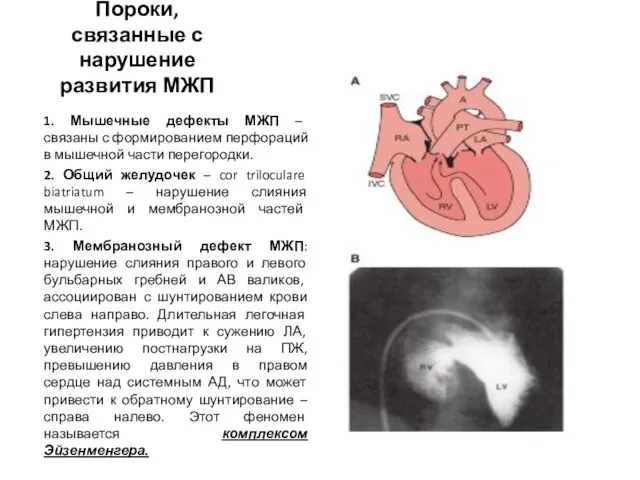 Пороки, связанные с нарушение развития МЖП 1. Мышечные дефекты МЖП –