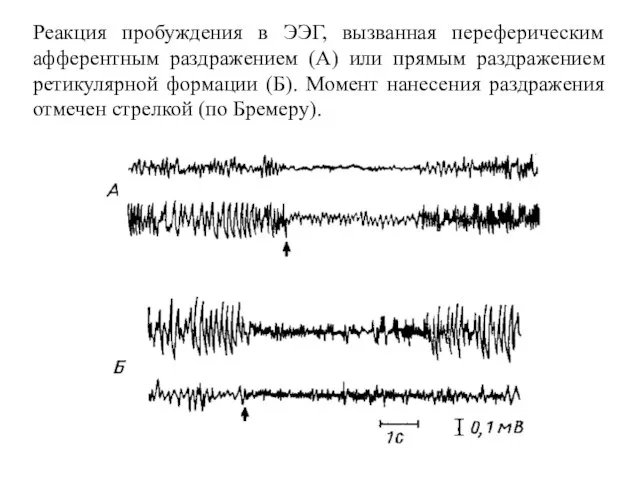 Реакция пробуждения в ЭЭГ, вызванная переферическим афферентным раздражением (А) или прямым