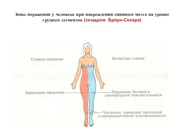 Зоны поражения у человека при повреждении спинного мозга на уровне грудных сегментов (синдром Броун-Секара)