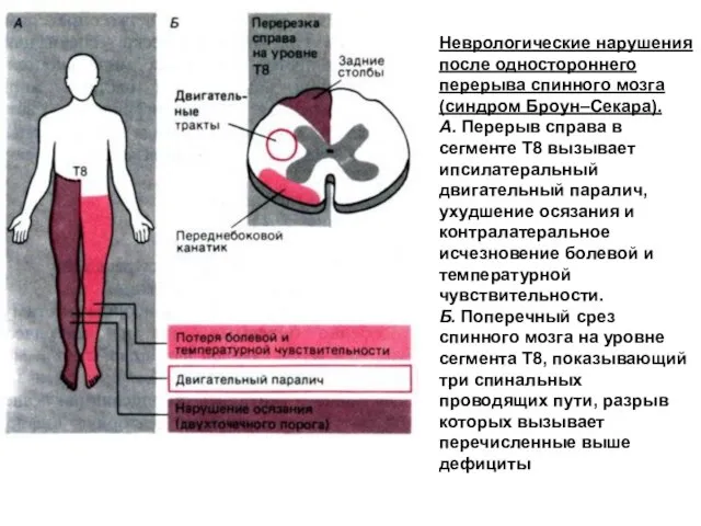 Неврологические нарушения после одностороннего перерыва спинного мозга (синдром Броун–Секара). А. Перерыв