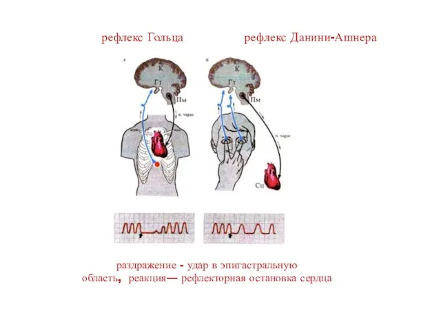 рефлекс Гольца рефлекс Данини-Ашнера раздражение - удар в эпигастральную область, реакция— рефлекторная остановка сердца