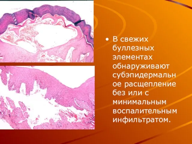 В свежих буллезных элементах обнаруживают субэпидермальное расщепление без или с минимальным воспалительным инфильтратом.