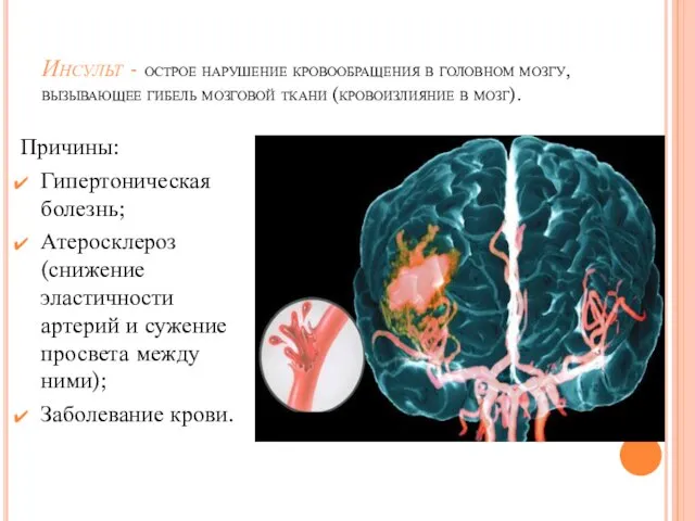 Инсульт - острое нарушение кровообращения в головном мозгу, вызывающее гибель мозговой