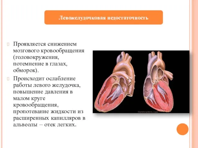 Проявляется снижением мозгового кровообращения (головокружения, потемнение в глазах, обморок). Происходит ослабление