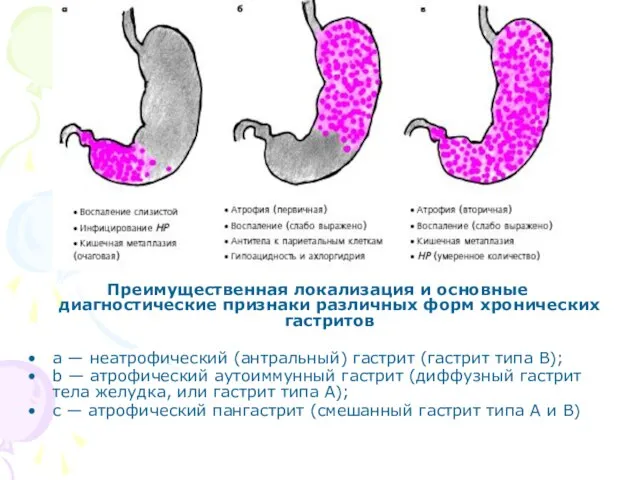 Преимущественная локализация и основные диагностические признаки различных форм хронических гастритов a